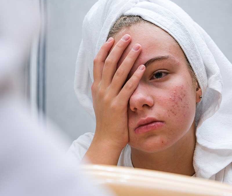 Kako stres utiče na kožu?