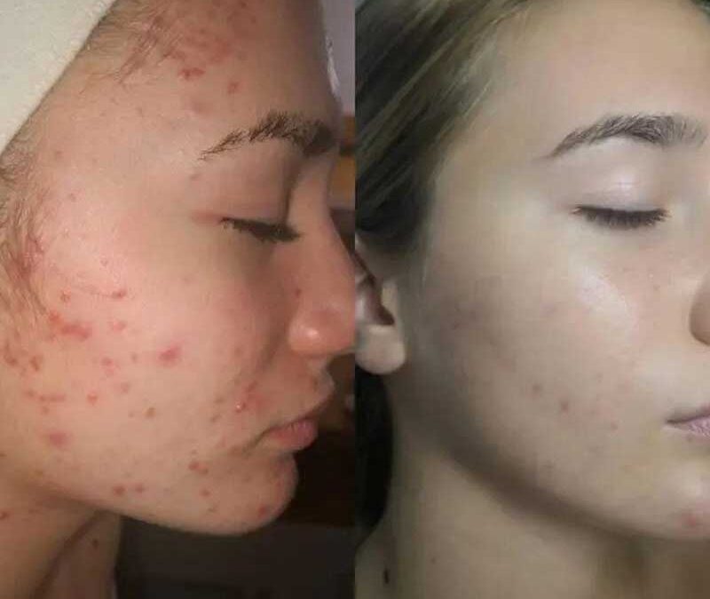 Akne na licu i telu – generacijski problem