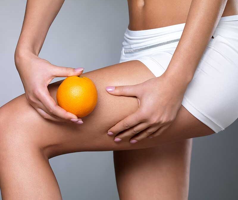 Šta je celulit, kako nastaje i kako ga se rešiti?