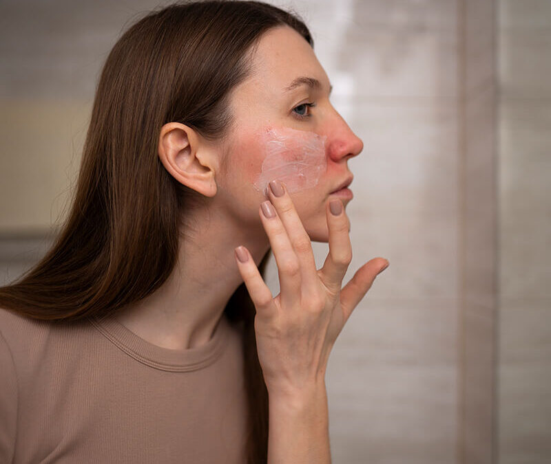 Rozacea – problematično stanje kože