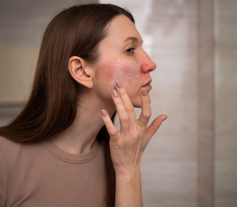 Rozacea - problematično stanje kože
