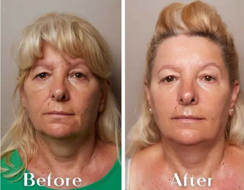 ULTRAZVUČNI LIFTING – ZATEZANJE LICA BEZ OPERACIJE I BEZ INVAZIVNIH ZAHVATA!