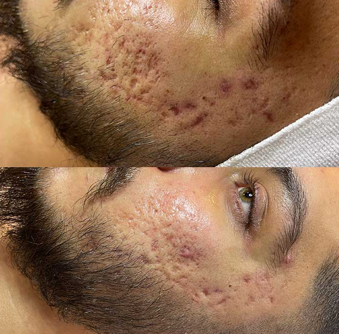 Akne – pokazatelji bolesti?