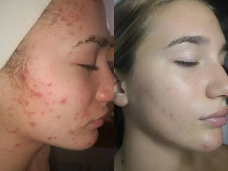 jetpeel pre i posle tretmana