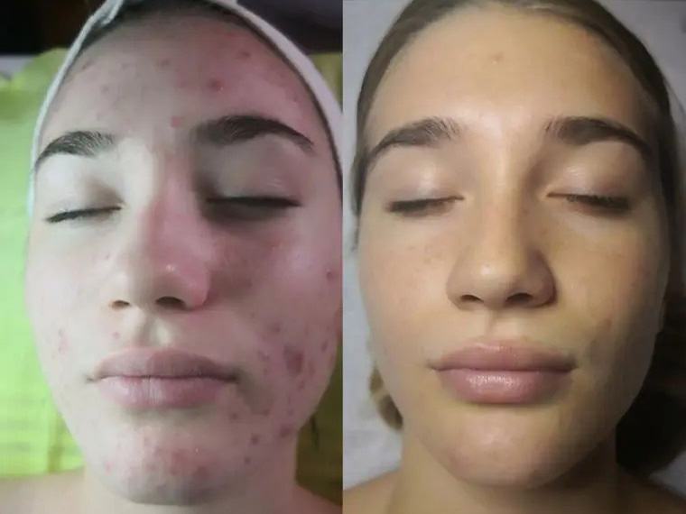 jetpeel pre i posle tretmana