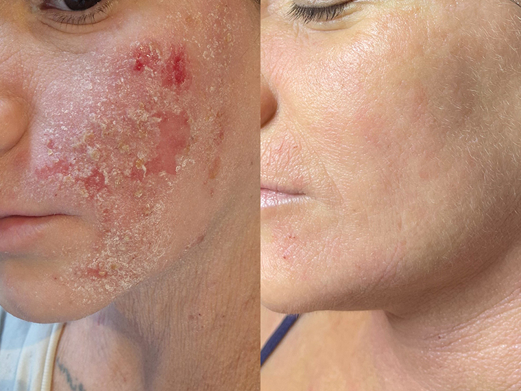 rezultati jetpeel tremtna