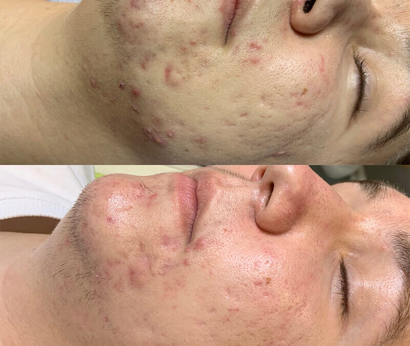 JetPeel i tretman akni