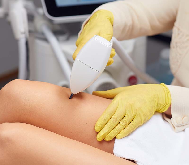 vasculaze-uklanjanje-kapilara