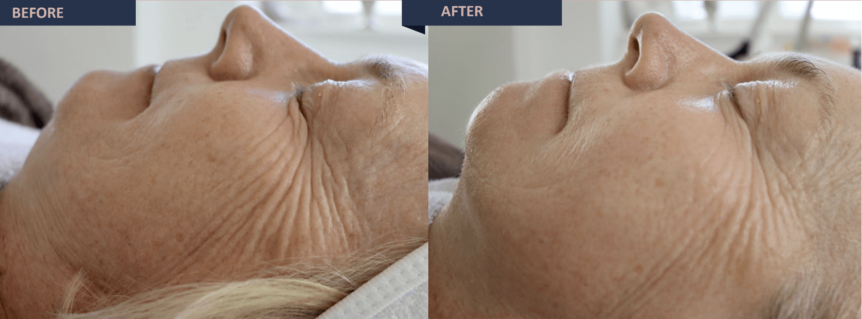 jetmed care before and after treatment jetpeel