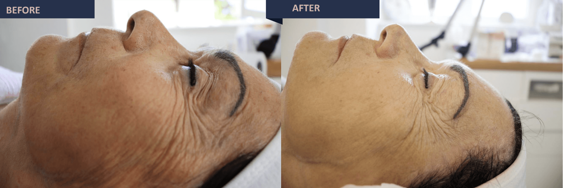 jetmed care before and after treatment jetpeel